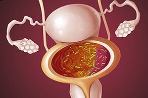 Cistită bacteriană la o femeie